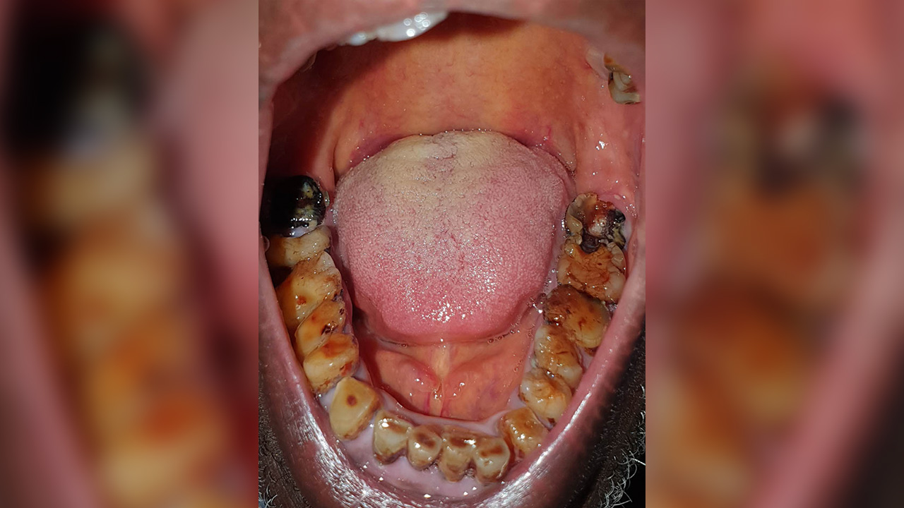 Pic showing inside the mouth of a patient and the tooth decay